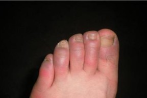 冻伤手指的应急处理方法（如何正确处理被冰箱冻伤的手指）
