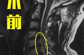 颈椎键盘突出属于什么病？如何预防和治疗？