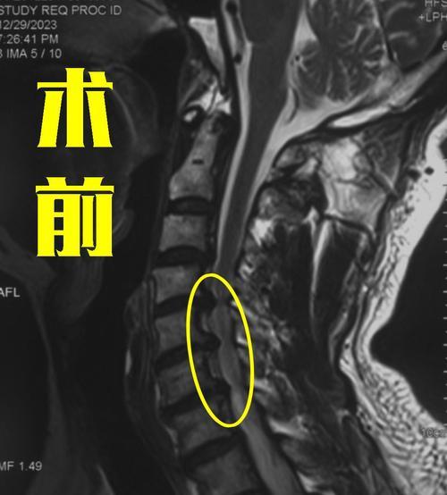 颈椎键盘突出属于什么病？如何预防和治疗？  第1张
